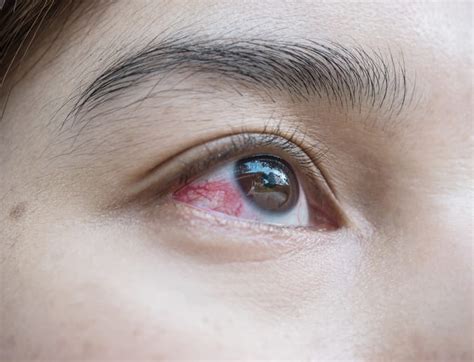 What Is At The Heart Of Eye Irritation Dry Eyes