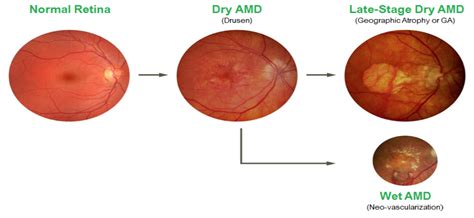 Age Related Macular Degeneration Amd And Low Vision Best Optometrist