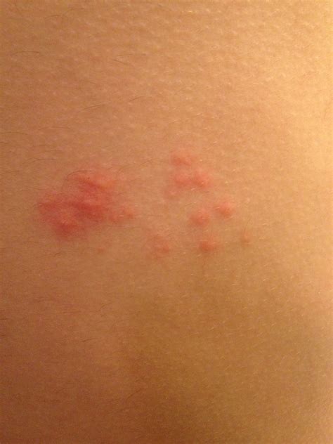 Itchy Chest Rash Pictures Photos