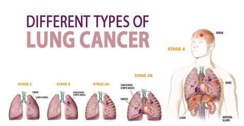 lung cancer types chart