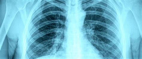 Western digital wd5000lplx 3 место: Tuberculosis (TB) - Anova Health Institute
