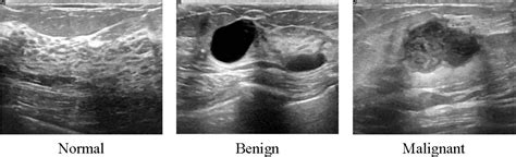 Dataset Of Breast Ultrasound Images Data In Brief