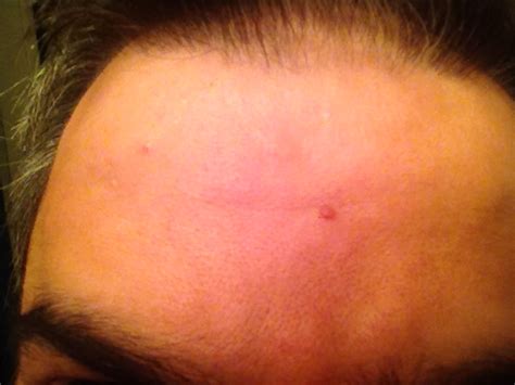 Hi I Have A Skin Growth On My Forehead For About 2 Months