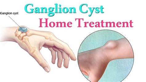 Ganglion Cyst On Ankle