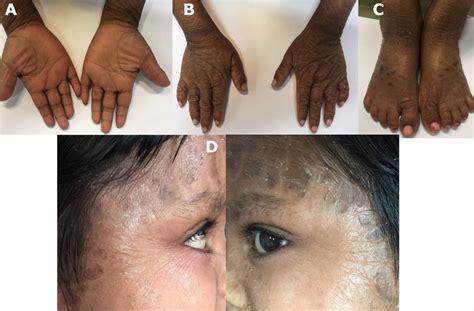 Oral Manifestations Of Lamellar Ichthyosis In Association With Rickets