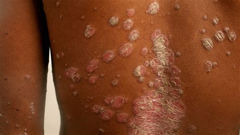 6 Skin Conditions That Are Signs Of Serious Health Issues — Guardian Life — The Guardian Nigeria