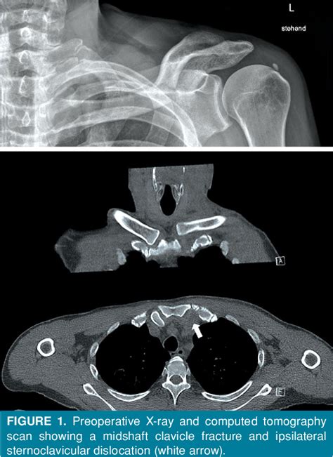 Figure 1 From Surgical Treatment Of Anterior Sternoclavicular