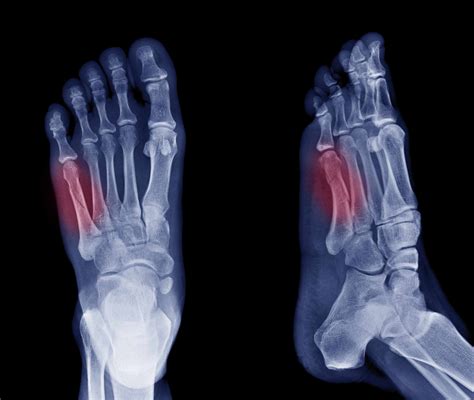 Understanding The Jones Fracture Of The Foot