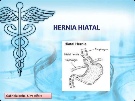 Hernia Hiatal Tipos Causas Y Tratamiento Ppt