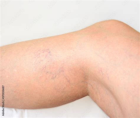 Varicose Veins In Female Legs The Leg Lies On A White Sheet Spider Veins Reticular Veins