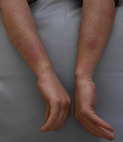 Imatinib Induced Erythema Nodosum A Case Report And Literature Review