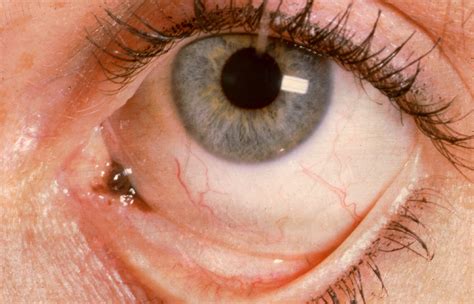 Study Shows Long Term Outcomes Of Conjunctival Melanoma Ophthalmology