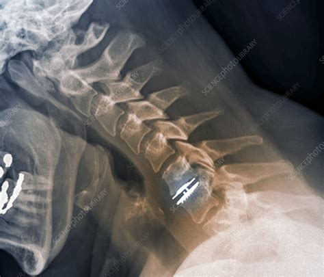 Spinal Disc Implant X Ray Stock Image C0239755 Science Photo
