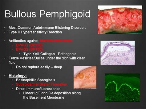 Pathophysiology Of Pemphigus Vulgaris Hot Sex Picture