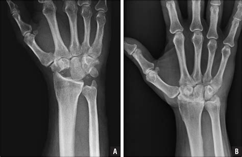 Total wrist arthroplasty froschauer sm, holzbauer m, hager d, kwasny o, duscher d. Osteochondral Resurfacing With Proximal Row Carpectomy: 8 ...