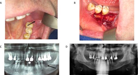Calcifying Odontogenic Cyst A Report Of Two Clinical Cases Journal