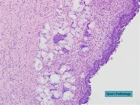Qiaos Pathology Bartholins Cyst Of Vulva Microscopic Ph Flickr