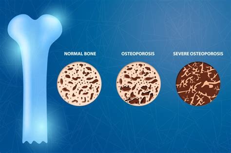Everything You Need To Know About Osteoporosis The Frisky