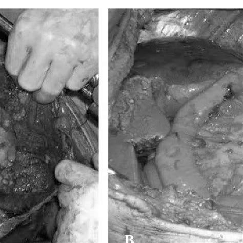 Malignant pleural mesothelioma (mpm) is the most common form of mesothelioma, accounting for approximately 80% of disease. Survival curve for epithelial mesothelioma | Download ...