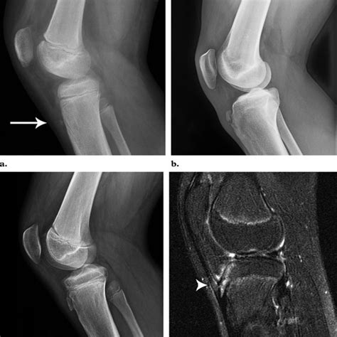 Osgood Schlatter Disease X Ray Captions Quotes