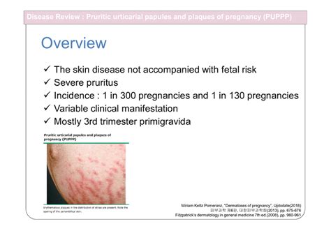 Pruritic Urticarial Papules And Plaques Of Pregnancy Puppp 피부과 대본있음 의약학