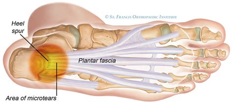 Plantar Fascitiis And Heel Pain Causes And Treatments Elite Podiatry