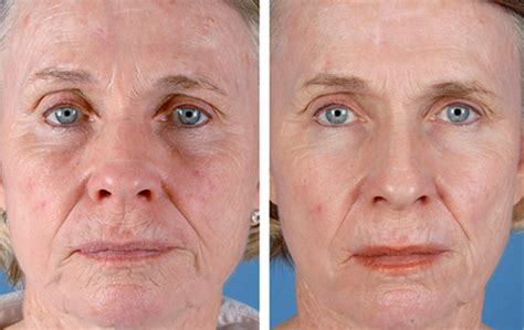And last but not least, make sure to apply it at night! Tretinoin before and after reddit : Candesartan ...