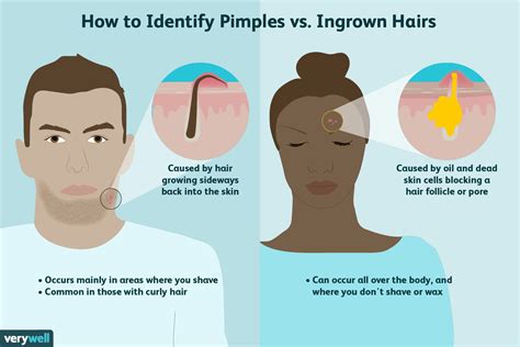 Ingrown Hair Vs Pimple Whats The Difference