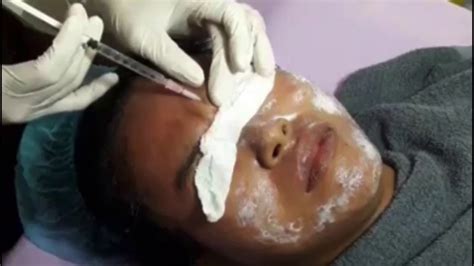 Blackhead Removal On Face For Women Youtube