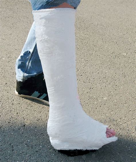 Stylish And Durable Leg Cast For Foot Injuries