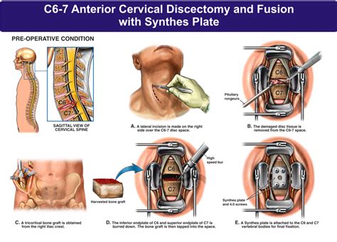 C6 7 Anterior Cervical Discectomy And Fusion With Synthes Plate Nbg