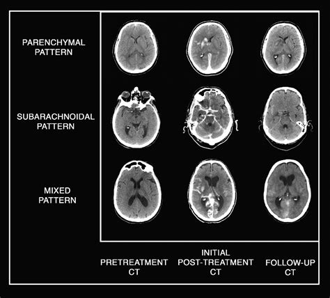 Acute Ischemic Stroke Ct Scan Ct Scan Machine Images