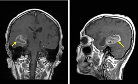 Glioblastoma Multiforme Radiology Cases