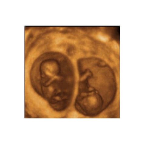 Mc Twins 11 Weeks 3d Ultrasound 3d Ultrasound Twins Ultrasound