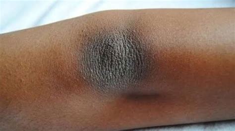 Dark Elbows Causes Remedies And Treatment
