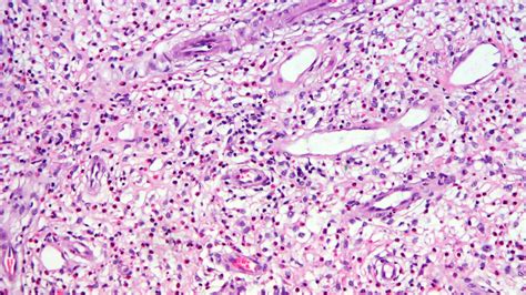 Pathology Outlines Inflammatory Fibroid Polyp