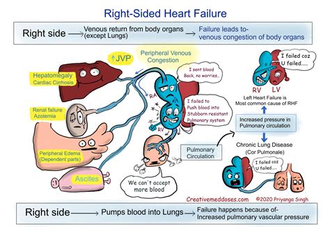 Heart Failure Left Sided Vs Right Sided Creative Med Doses