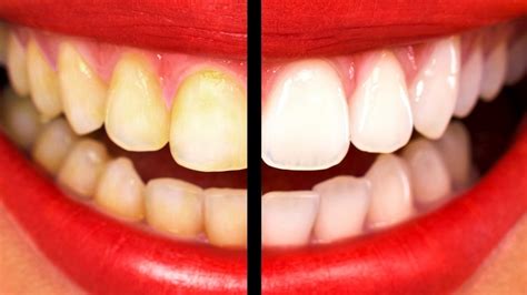 9 Astuces Pour Blanchir Vos Dents Naturellement