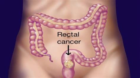 Rectum Cancer Symptoms And Treatment By Stage Health Digest