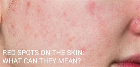 Red Spots On The Skin What Can They Mean