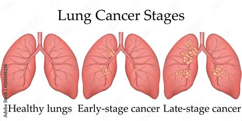 Vector Medical Illustration Of Human Lung Cancer Development Process