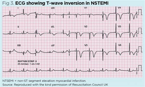 Electrocardiogram 2 Interpretation And Signs Of Heart Disease