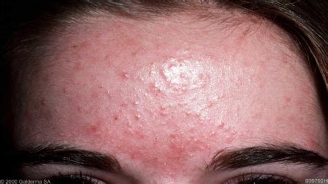 8 Skin Conditions That Look Like Acne But Are Not Bestemsguide