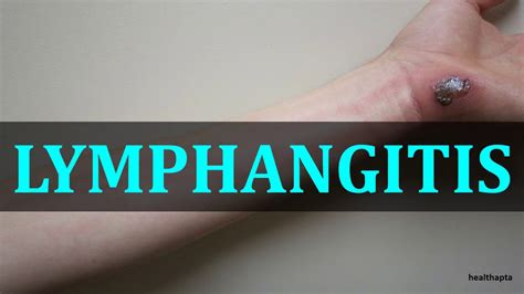 Lymphangitis Youtube