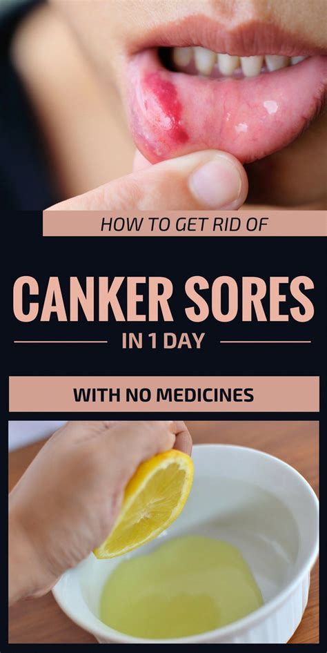 How To Get Rid Of Canker Sores In 1 Day With No Medicines Canker Sore
