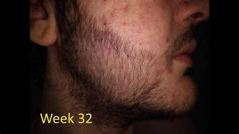 I'm pleased with the results so far, so i figured i'd make a video on the way i apply it so everyone can see what i do and compare it. 5% Minoxidil Beard Journey Before and After (32 Weeks ...