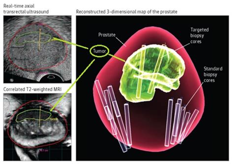 Prostate Biopsy Trus Or Mri Us Fusion Method Chin Chong Min Urology