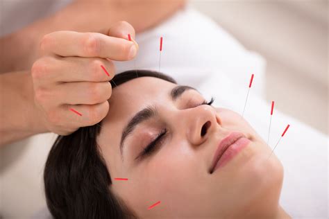Acupuncture For Bell S Palsy The Best Acupuncturist In Irvine