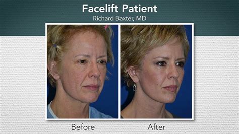 How To Insure Invisible Facelift Scars The Plastic Surgery Channel