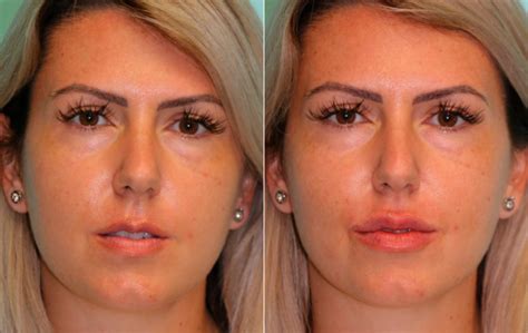 Lip Augmentation Photos Chevy Chase Md Patient 15747